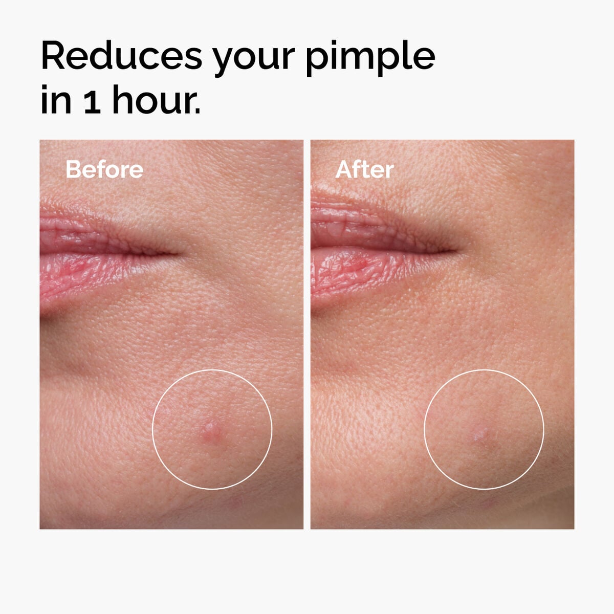 Sulfur 10% Powder-to-Cream Acne Treatment