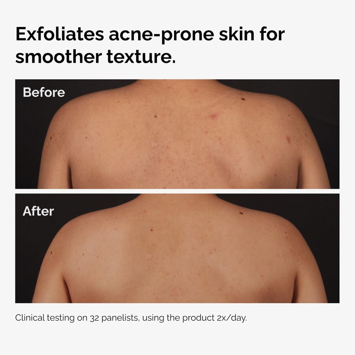 Salicylic Acid 0.5% Exfoliating Body Serum