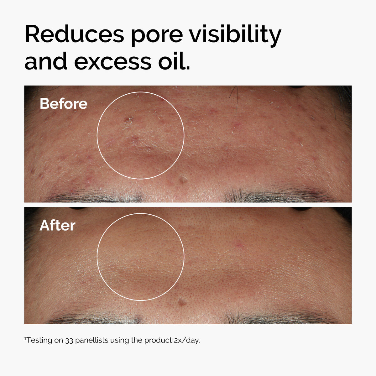Niacinamide 10% + Zinc 1% Blemish Serum