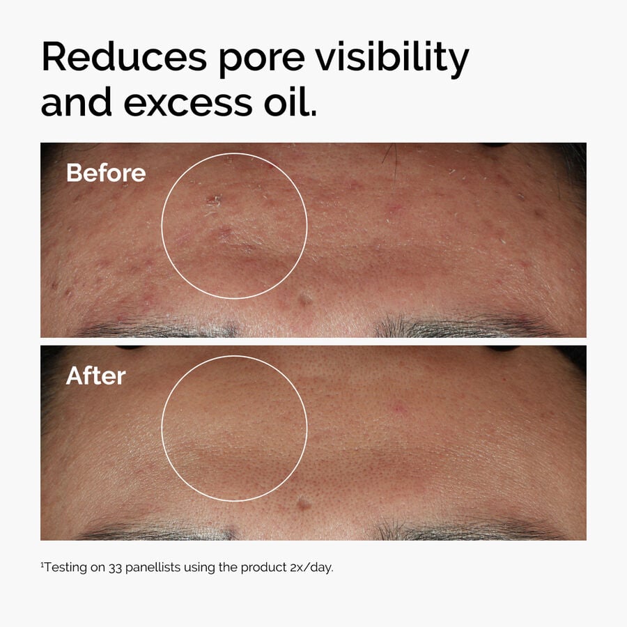 Niacinamide 10% + Zinc 1% Blemish Serum